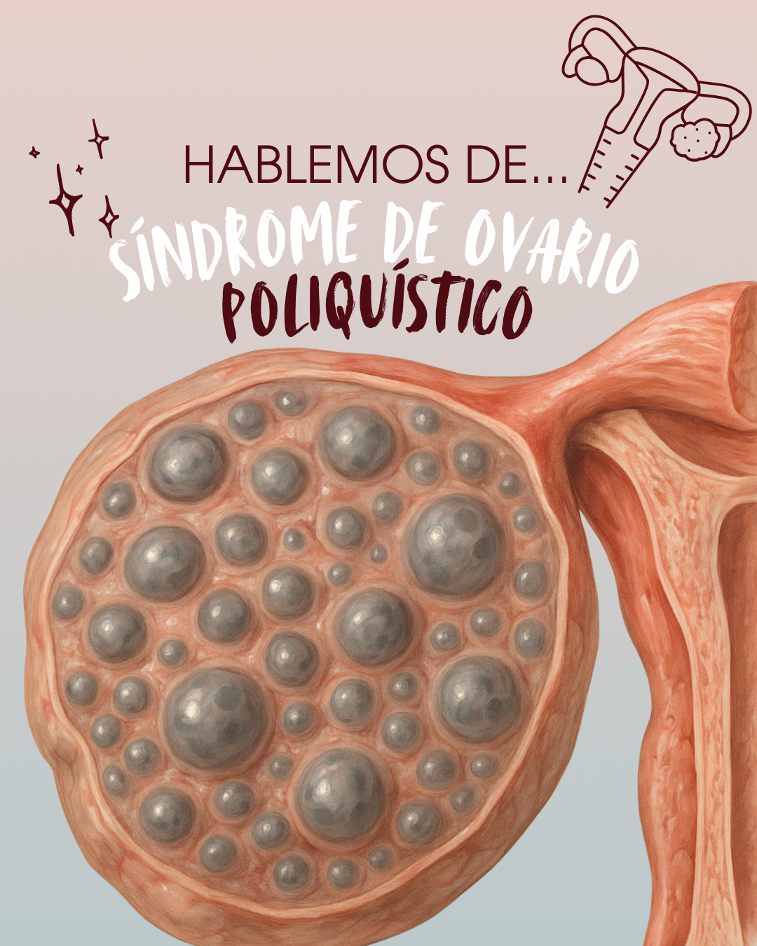 El Síndrome de Ovario Poliquístico: lo que nadie explica con claridad